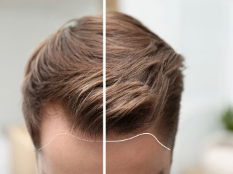 Hair Transplant Consultation in USA 2025 | Best Doctors &amp; Prices